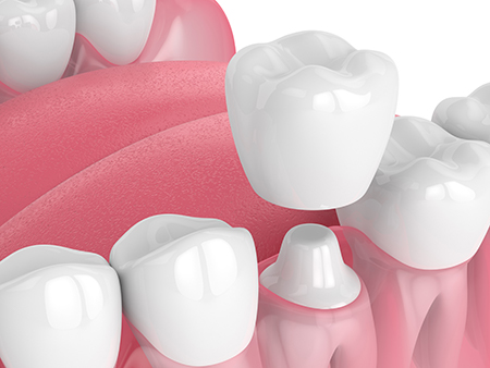 The image features a close-up view of multiple teeth with varying shades of pink and white, arranged in a row against a white background.
