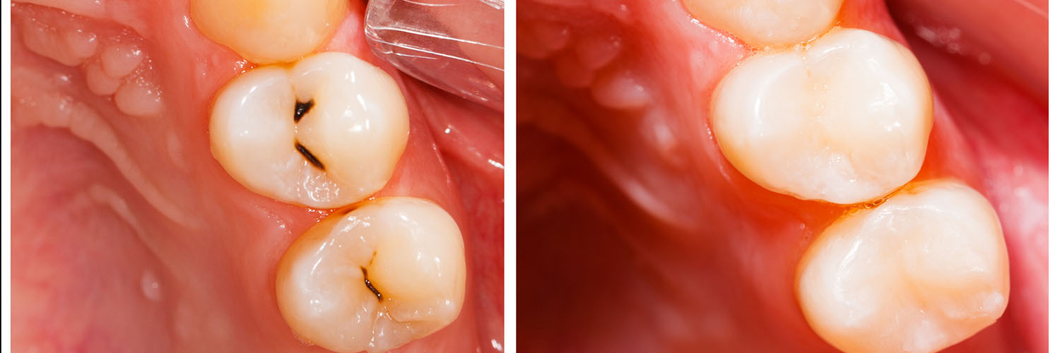 The image displays a close-up view of a human mouth with teeth showing signs of decay and damage, including cavities and missing enamel, against a blurred background that suggests a medical or dental setting.