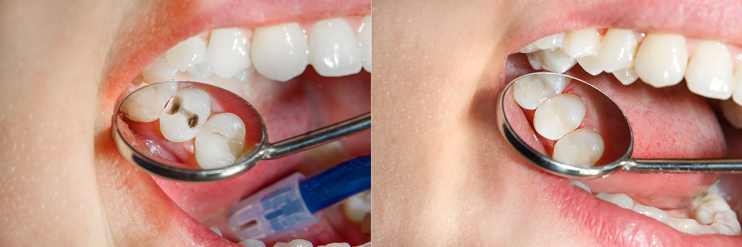 The image shows two photos of a person s mouth with a toothbrush, a toothpick, and dental floss, with one photo showing the cleaning process and the other showing the result of brushing and flossing.