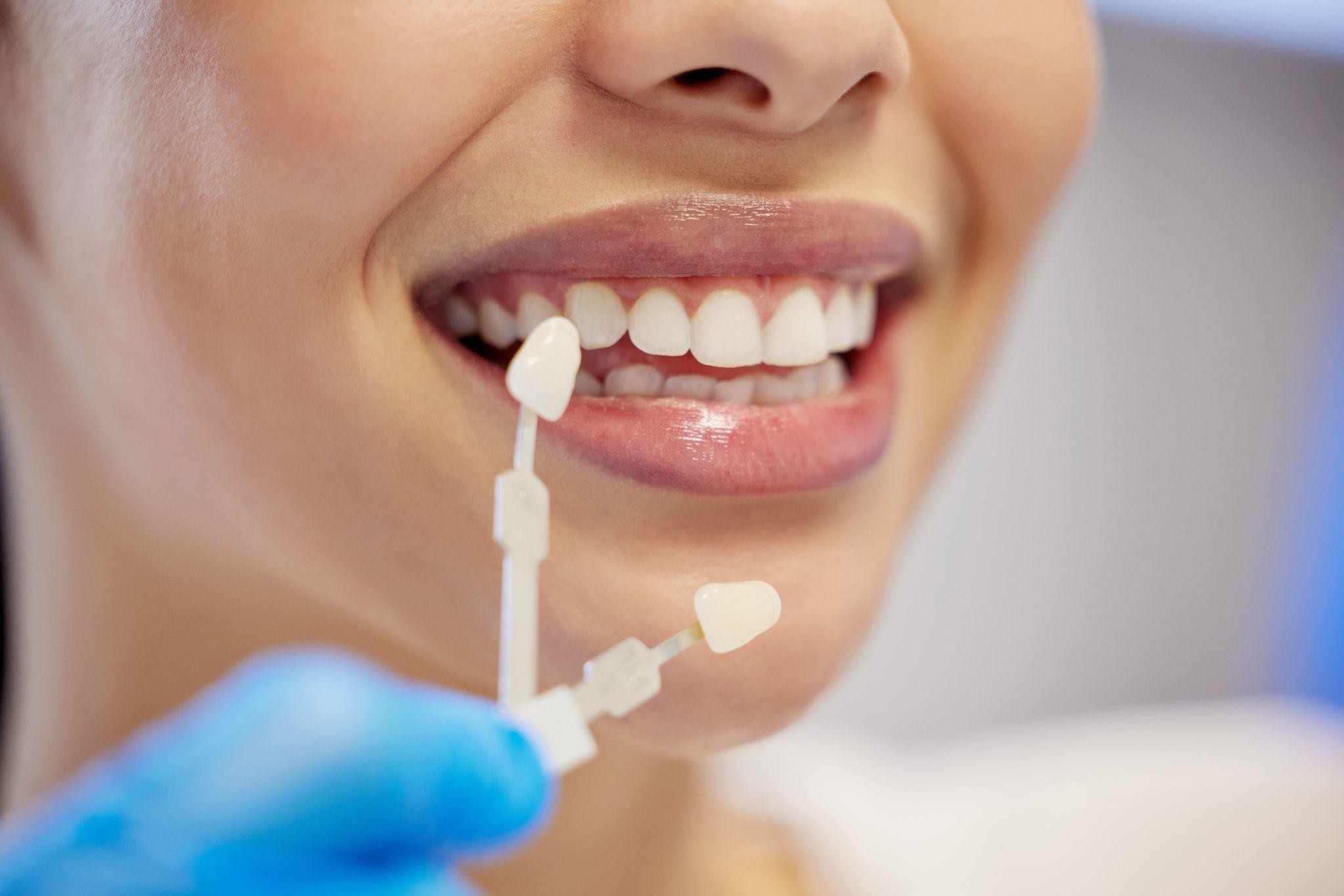 How You Can Make Your Teeth Whitening Results Last Years, Not Months