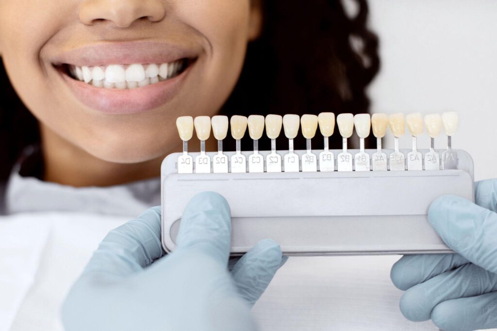 Dental shade guide showing tooth color comparison during professional teeth whitening at a cosmetic dental clinic in Bradenton.